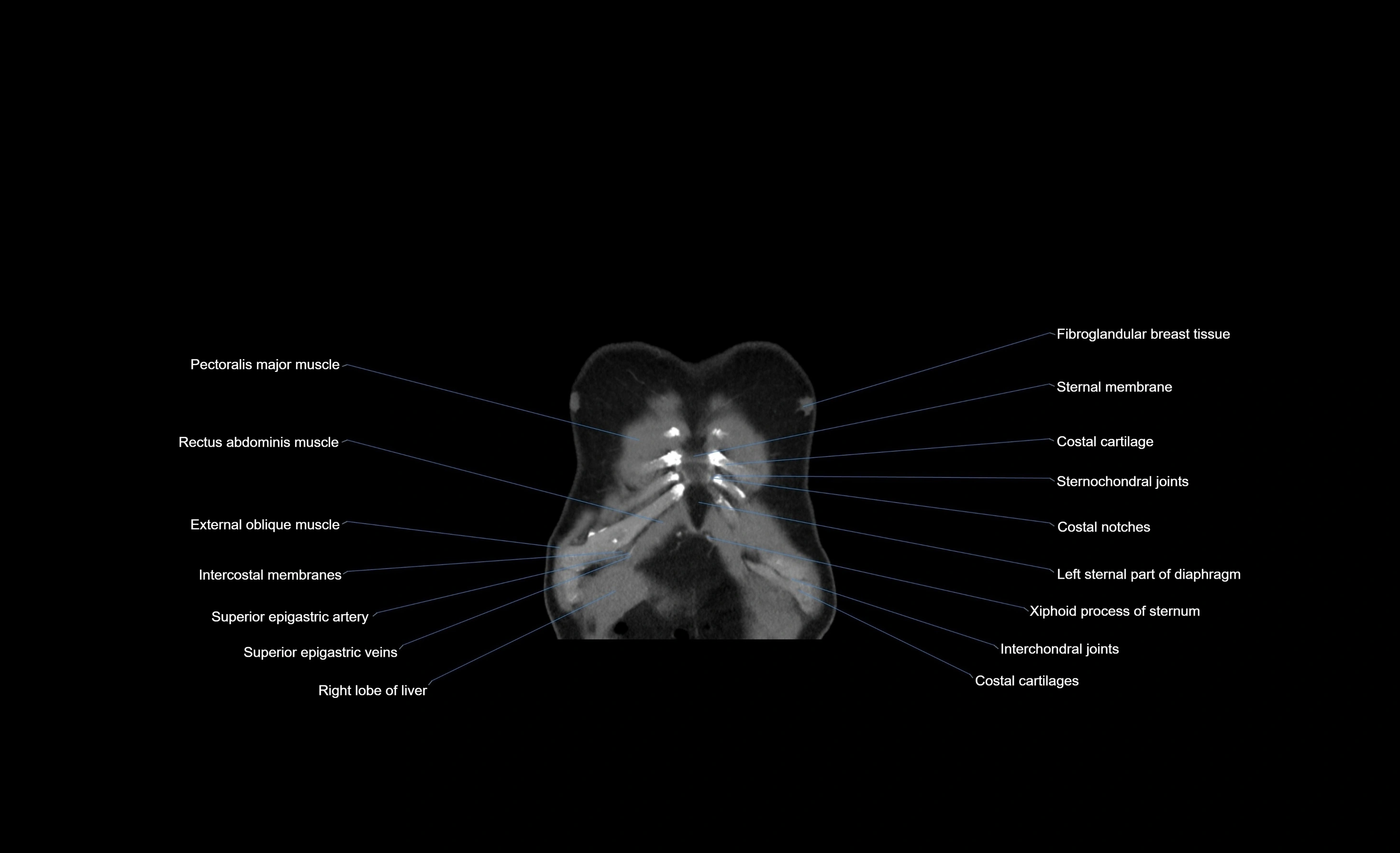 CT chest (thorax) soft tissue window labelled coronal cross sectional anatomy radiology image-00105.webp